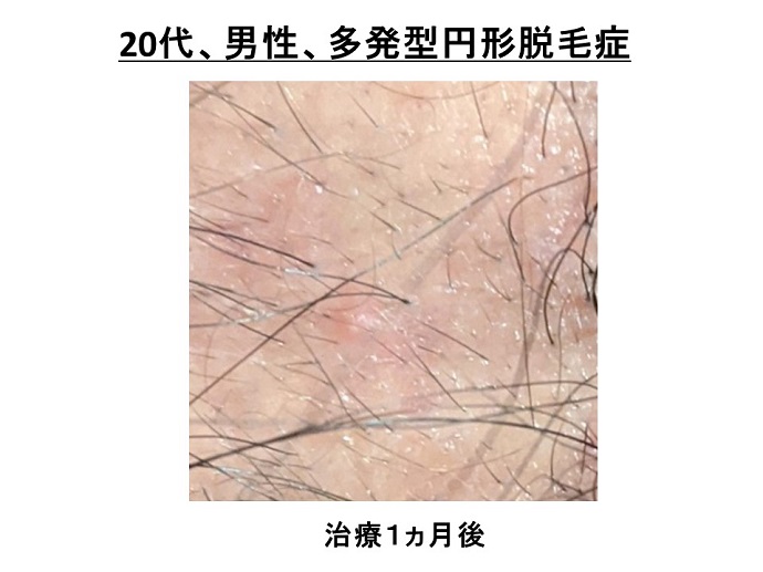 円形脱毛症　病院